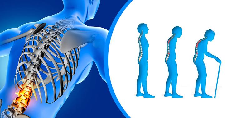 Osteoporozda umurtqa pog'onasi o'zgarishi