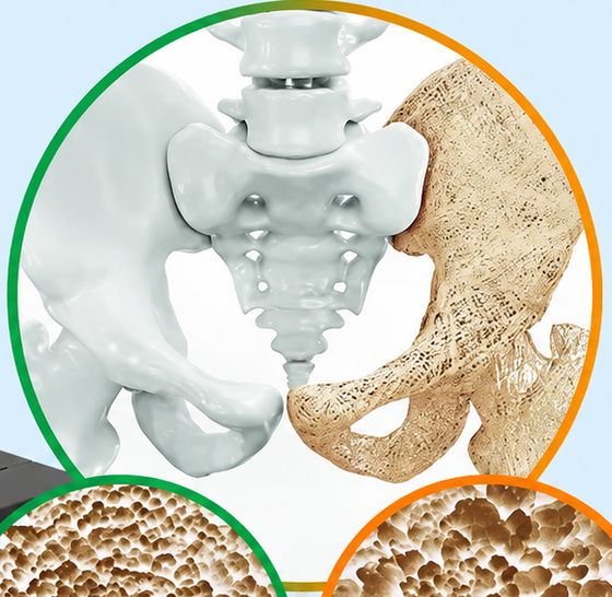 Sog'lom va osteoporozli chanoq-son suyagi taqqoslanishi